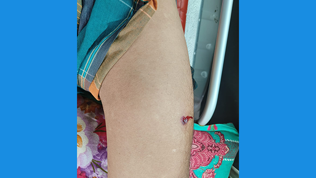 মাদক ব্যবসায়ীদের গুলিতে আব্দুল হামিদ নামে এক সোর্স গুরুতর আহত হয়। ছবি : সংগৃহীত